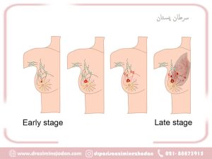 راهنمای جامع درمان سرطان پستان: از جراحی‌های نوین تا انتخاب بهترین جراح