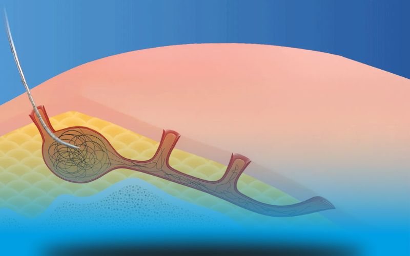 لیزر کیست مویی