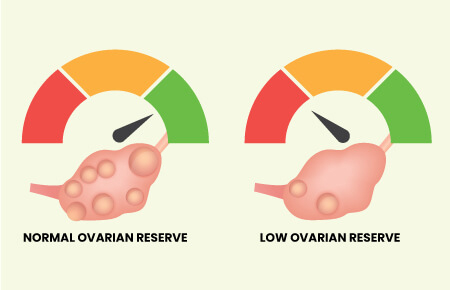 همه‌چیز درباره کاهش ذخیره تخمدان؛ از علائم تا راه‌های درمان