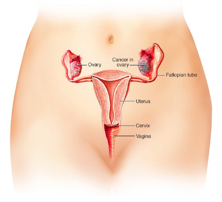 جراحی اوفورکتومی, بهبودی پس از اوفورکتومی