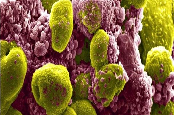 تاثیر یک ترکیب دارویی در کاهش خطر مرگ ناشی از سرطان تاثیر یک ترکیب دارویی در کاهش خطر مرگ ناشی از سرطان