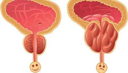 درمان پروستات درمان پروستات
