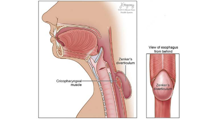 دیورتیکولوم زنکر, اختلال بلع در سالمندان