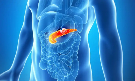 علائم سرطان پانکراس در پاها, درد پا و سرطان پانکراس