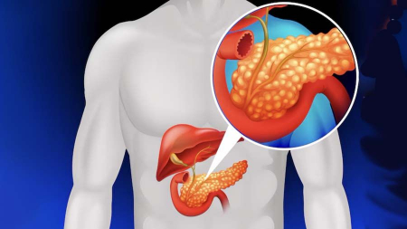 علائم سرطان پانکراس در پاها, درد پا و سرطان پانکراس