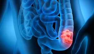 چطور جلوی سرطان روده را بگیریم؟