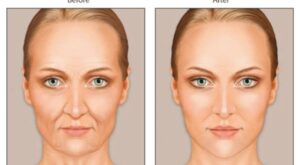 آیا تزریق چربی به صورت روشی دائمی است؟