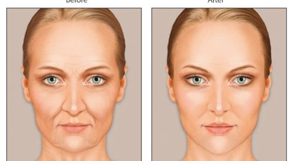 آیا تزریق چربی به صورت روشی دائمی است؟