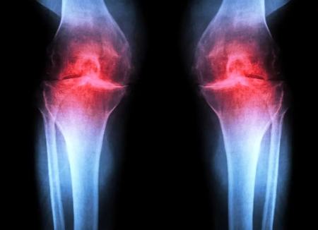 آرتروز،اخبار پزشکی،خبرهای پزشکی آرتروز،اخبار پزشکی،خبرهای پزشکی