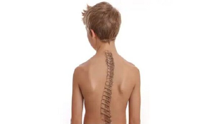 اسکولیوز تهدید خاموش ستون فقرات کودکان است؛ از هر ۲۰ نفر یک مبتلا