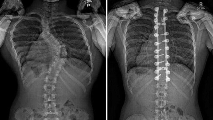 اسکولیوز تهدید خاموش ستون فقرات کودکان است؛ از هر ۲۰ نفر یک مبتلا
