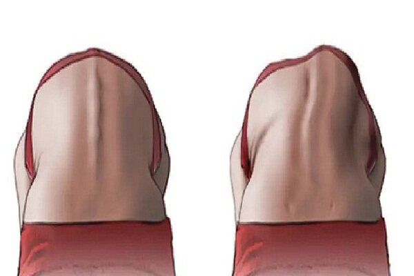 اسکولیوز تهدید خاموش ستون فقرات کودکان است؛ از هر ۲۰ نفر یک مبتلا