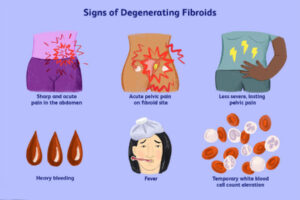 ترکیدگی فیبروم رحمی؛ عوارض، علل و راه‌های پیشگیری