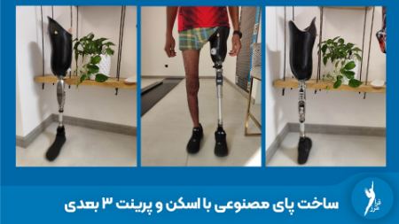 ساخت پای مصنوعی در کلینیک ارتوپدی فنی فرامرز ساخت پای مصنوعی در کلینیک ارتوپدی فنی فرامرز