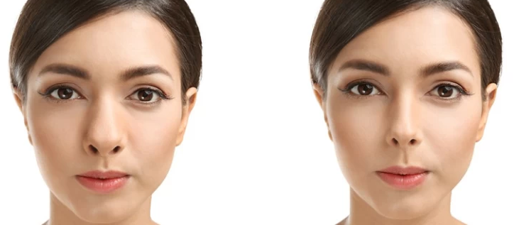 هزینه عمل بینی گوشتی و پهن در سال 1404 چقدر است؟