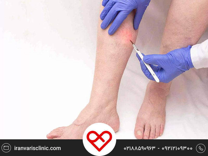 آشنایی با روش های موثر درمان واریس در سالمندان