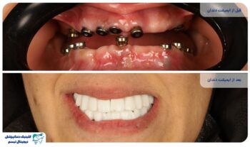 ایمپلنت یک روزه : آنچه بیماران باید قبل از تصمیم بدانند!