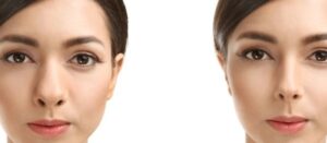 هزینه عمل بینی گوشتی و پهن در سال ۱۴۰۴ چقدر است؟