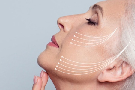 لیفت صورت بعد از 50 سالگی