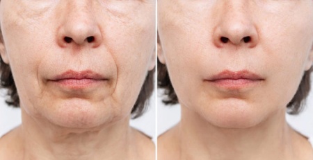 ماندگاری لیفت صورت