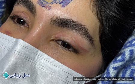 بلفاروپلاستی