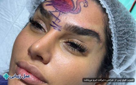 لیفت دایرکت ابرو