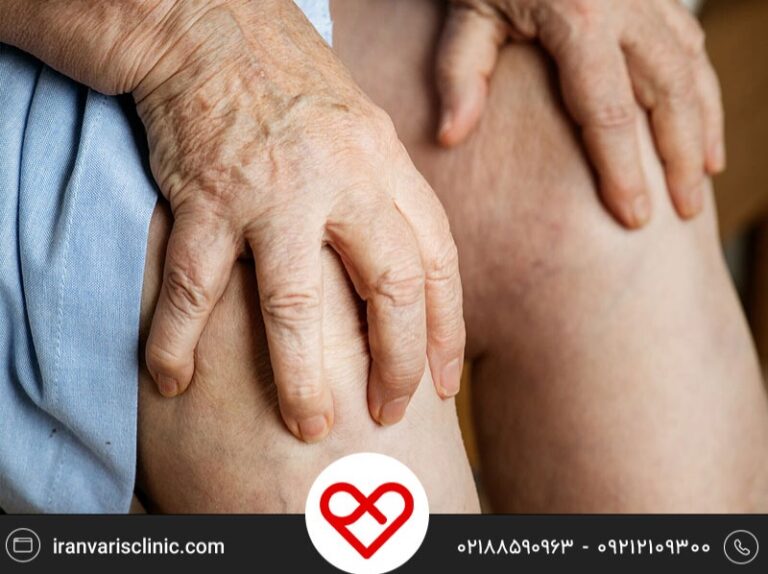 آشنایی با روش های موثر درمان واریس در سالمندان