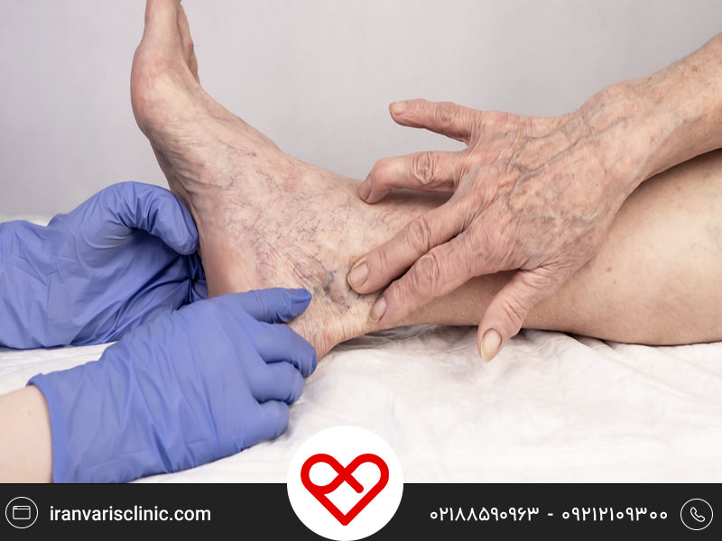 آشنایی با روش های موثر درمان واریس در سالمندان