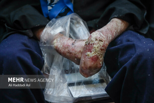 ارسال ۱۰۰۰ دارو و ۹۷۰ پانسمان بیماران پروانه ای