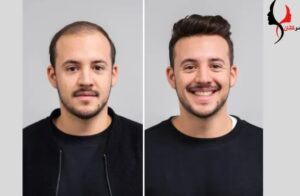چند وقت یکبار باید پروتز مو را تعویض کرد؟