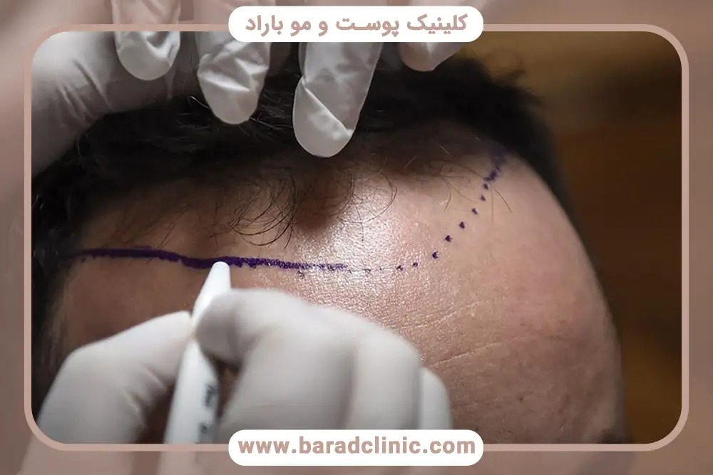 راهنمای جامع خدمات کاشت ؛ از کاشت مو و ریش تا کاشت ابرو و روش‌های زیبایی