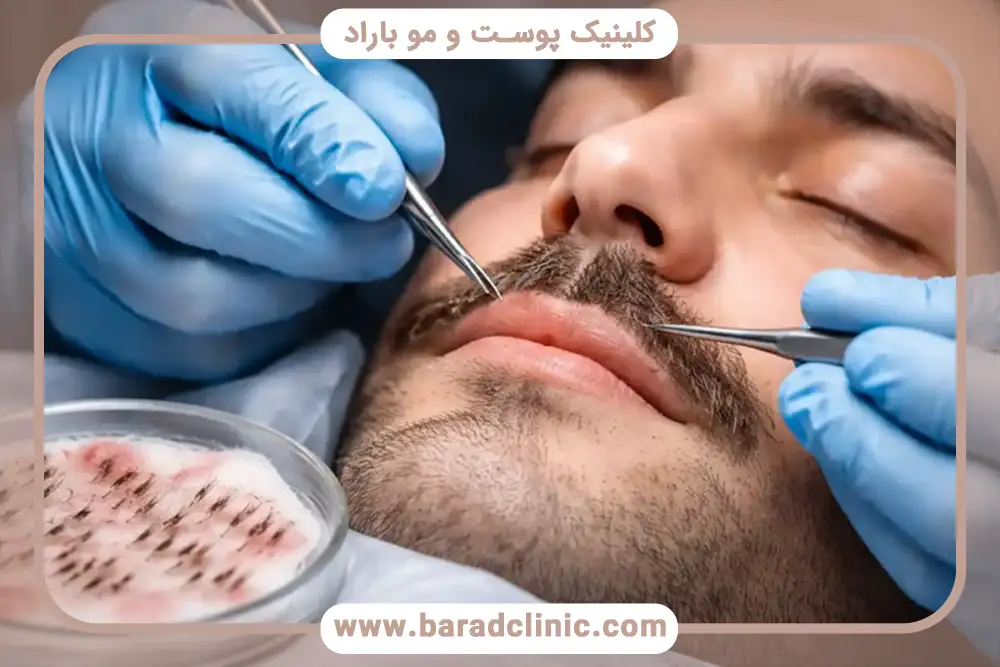 کاشت ریش چیست ؟ خدمات کاشت ریش در کلینیک باراد