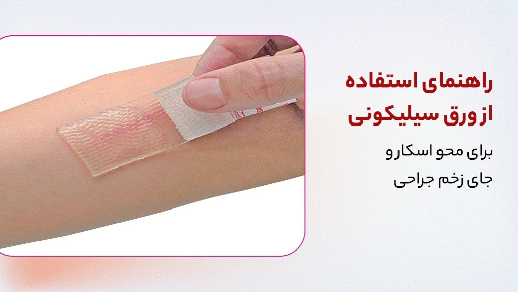 راهنمای استفاده از ورق سیلیکونی برای محو اسکار و جای زخم جراحی