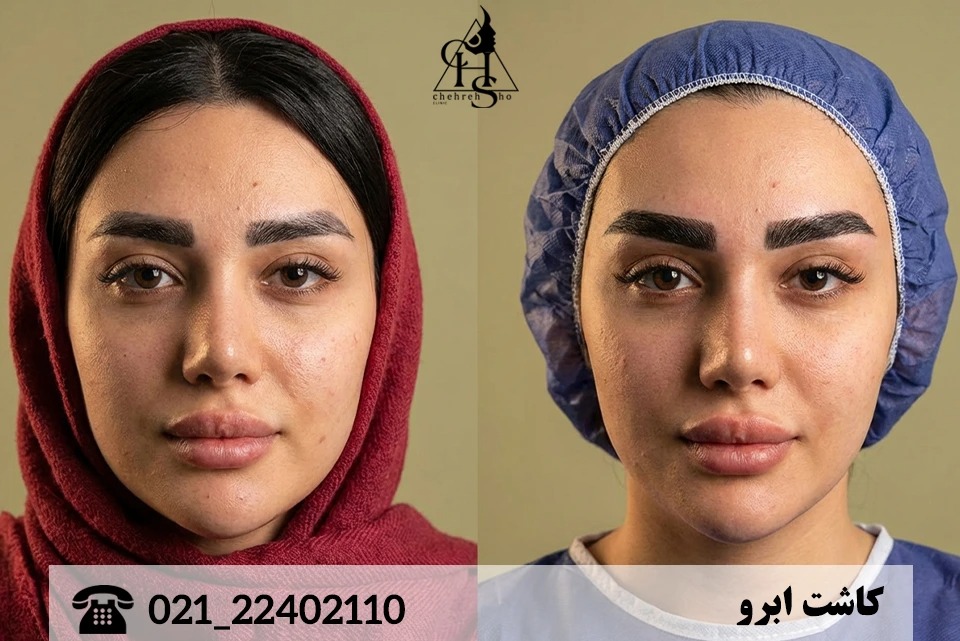 ترمیم کاشت ابرو ناموفق؛ چگونه ابروی عروسکی و سیخ‌شده را اصلاح کنیم؟