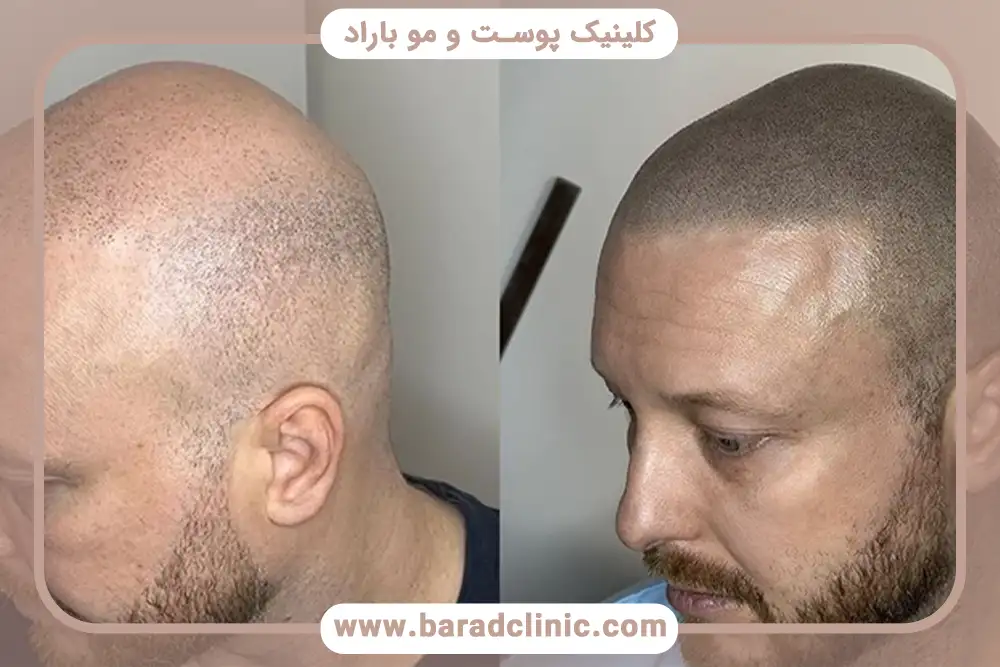 کاشت مو چیست؟ کاشت مو در کلینیک باراد