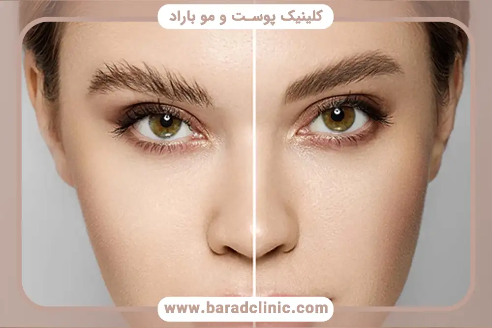 خدمات کاشت ابرو