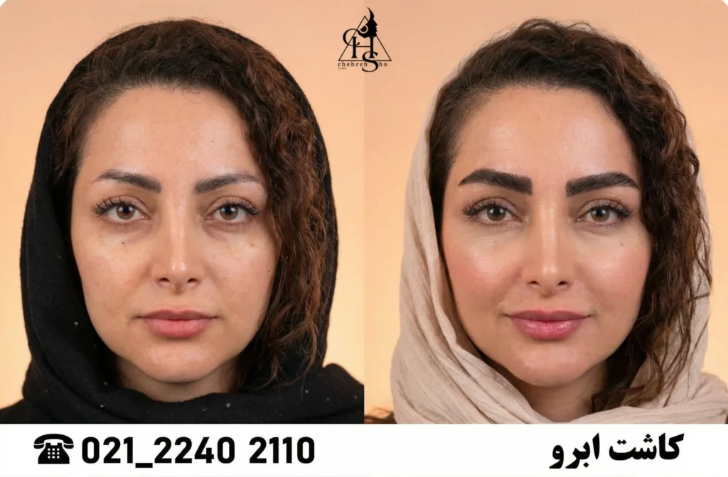 ترمیم کاشت ابرو چهره شو