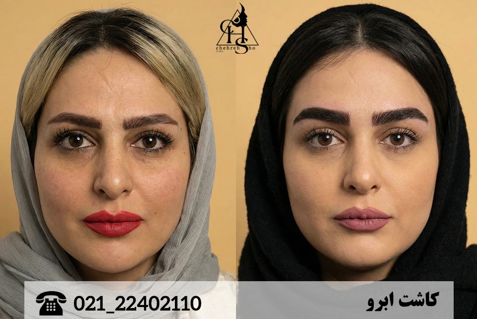 ترمیم کاشت ابرو ناموفق